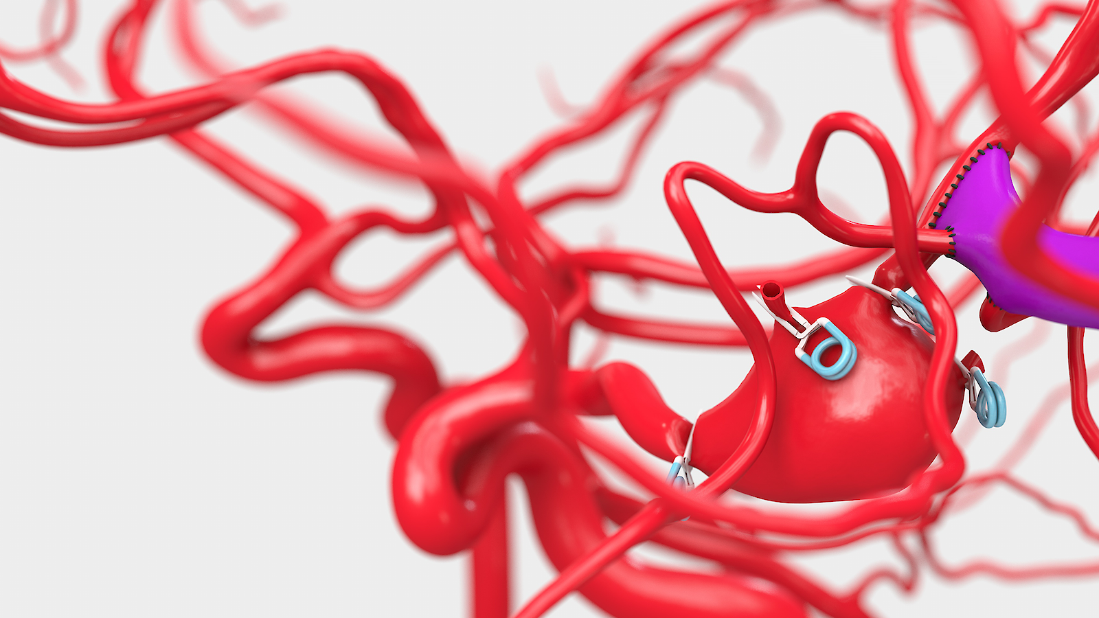 Zoom view of a situation at the bifurcation of the M1 segment of the arteria cerebri media with aneurysm and treatment by means of clips and a bypass.
